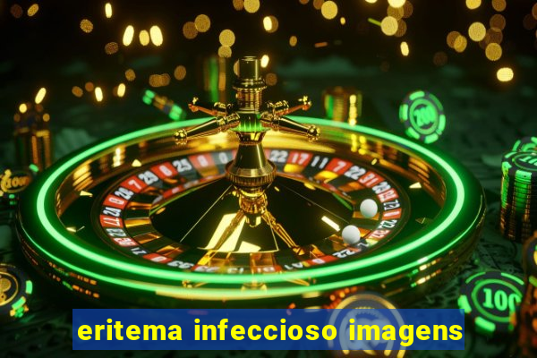 eritema infeccioso imagens